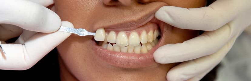 Couronnes dentaires à Bussigny