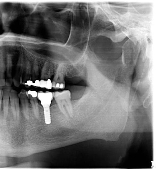 Implants dentaires à Bussigny